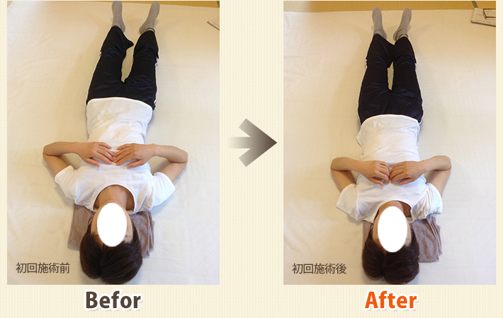 患者さんビフォーアフター　その12