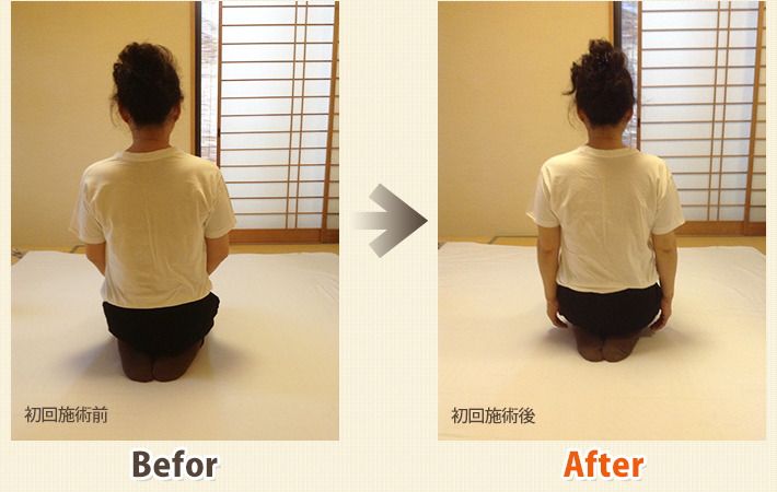 患者さんビフォーアフター　その15