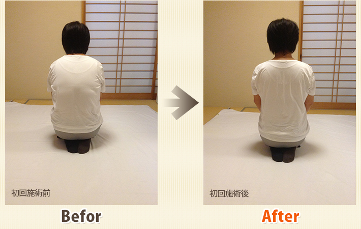 患者さんビフォーアフター　その16